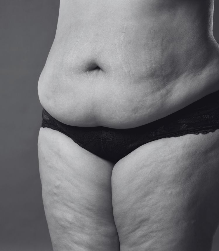 Image comparing mild and severe cellulite grades Clifton