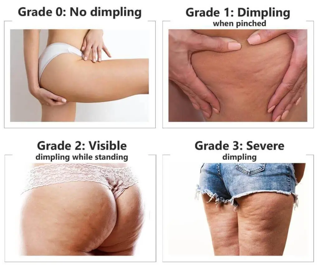 Representation of the stages of cellulite development Clifton